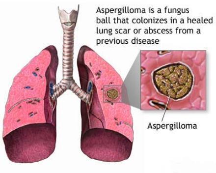 اسپیرژیلوز (Aspergillosis)