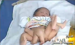 تولد یک نوزاد 6 پا در پاکستان + عکس