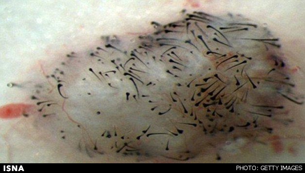  درمان کچلی موشها با سلول بنیادی انسان