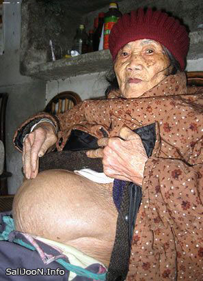 پیر زنی در چین بچه ای سنگی به دنیا آورد
